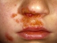 Infecciones bacterianas en la piel típicas de la edad pediátrica