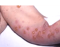 Infecciones bacterianas en la piel típicas de la edad pediátrica
