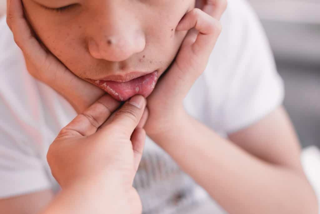 Aftas o úlceras bucales en niños: por qué salen y remedios