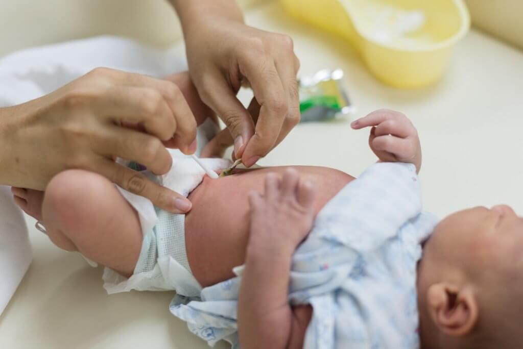 Cuidados del ombligo del recién nacido para evitar infección