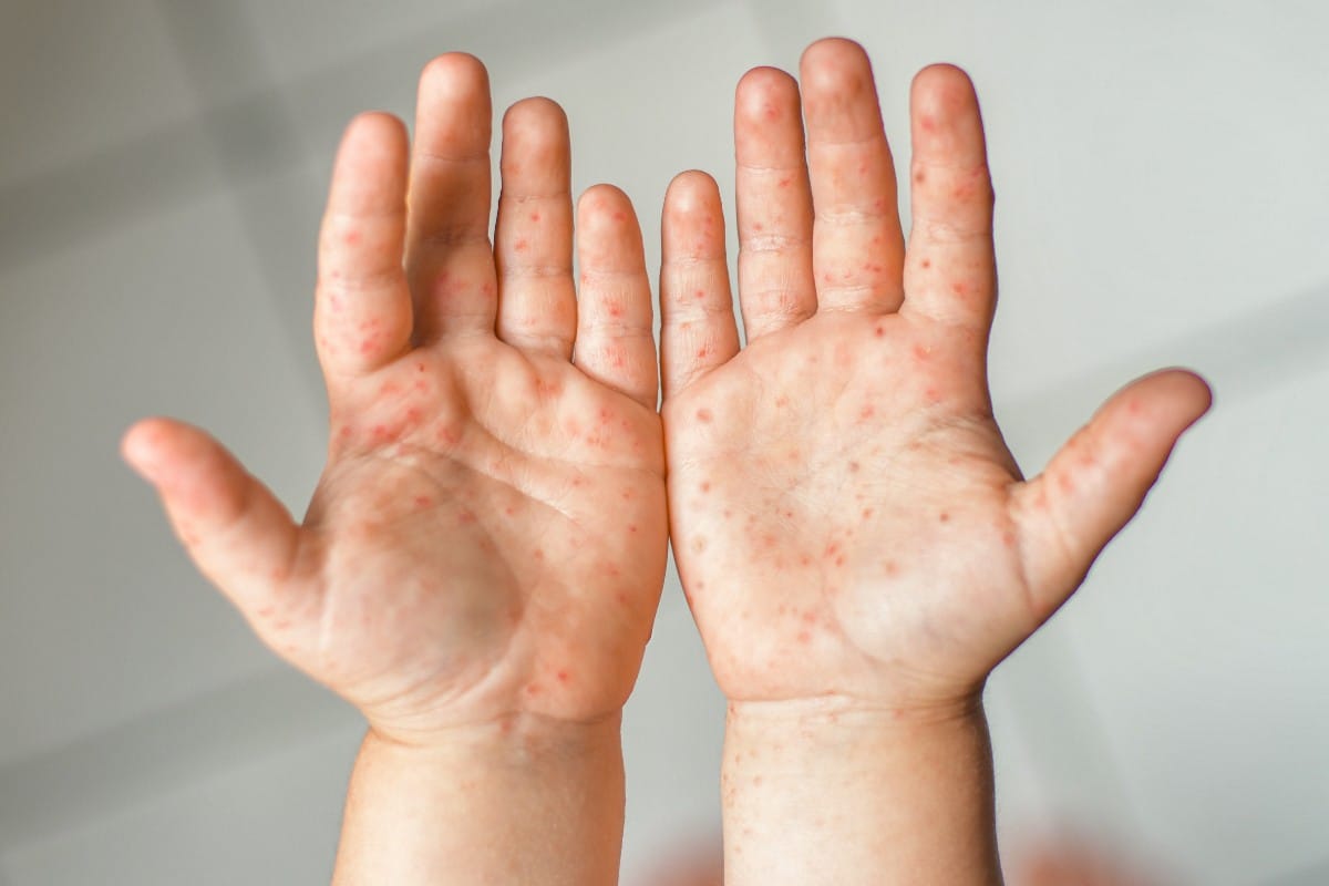 Virus boca manos pies en niños: síntomas y tratamientos
